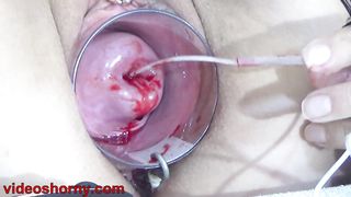 Japanese Vibrator into Uterus with Injected Sperm insemination