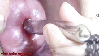 Insertion the catheter in Cervix women Mature